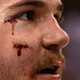 Illustration for article titled Andrew Shaw To Auction Off The Stitches From His Glorious Hockey Face
